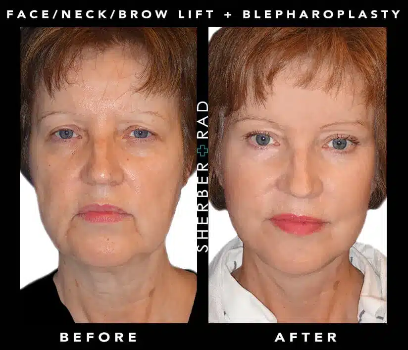Deep Plane Facelift before and after photos by Sherber and Rad in Washington