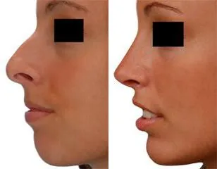 Chin + Jaw Reshaping before and after photos by Sherber and Rad in Washington, DC