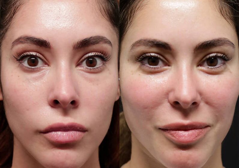 Brow + Forehead Lift before and after photos by Sherber and Rad in Washington, DC