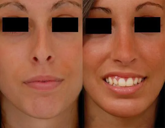 Chin + Jaw Reshaping before and after photos by Sherber and Rad in Washington, DC