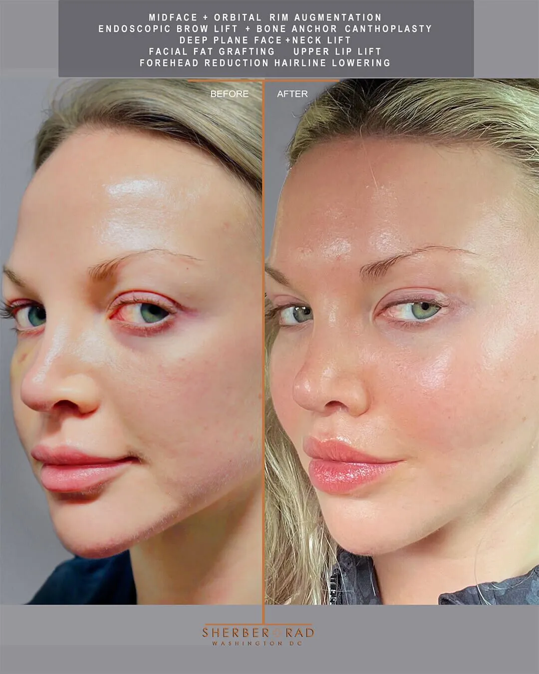 Deep Plane Facelift before and after photos by Sherber and Rad in Washington