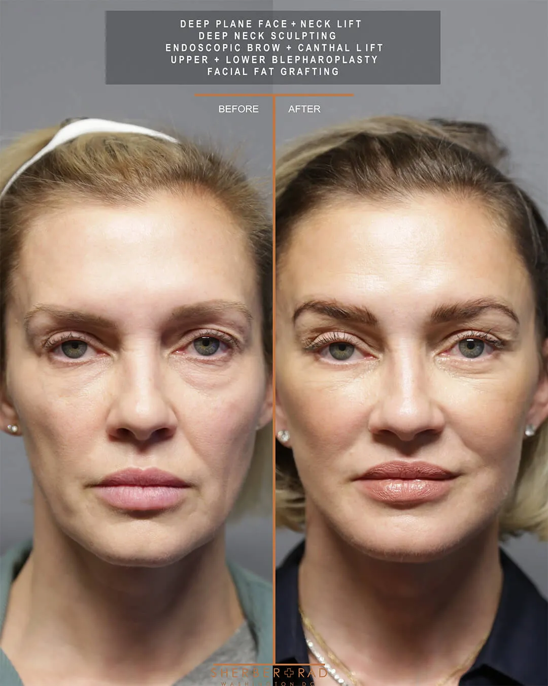 deep plane facelift before and after photos by sherber and rad in washington dc