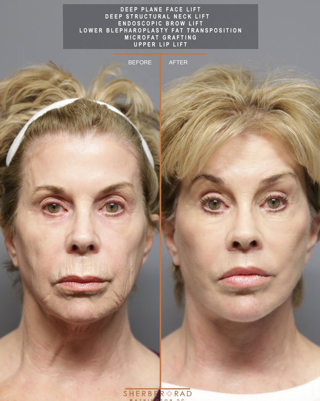 Facial Optimization before and after photos by Sherber and Rad in Washington
