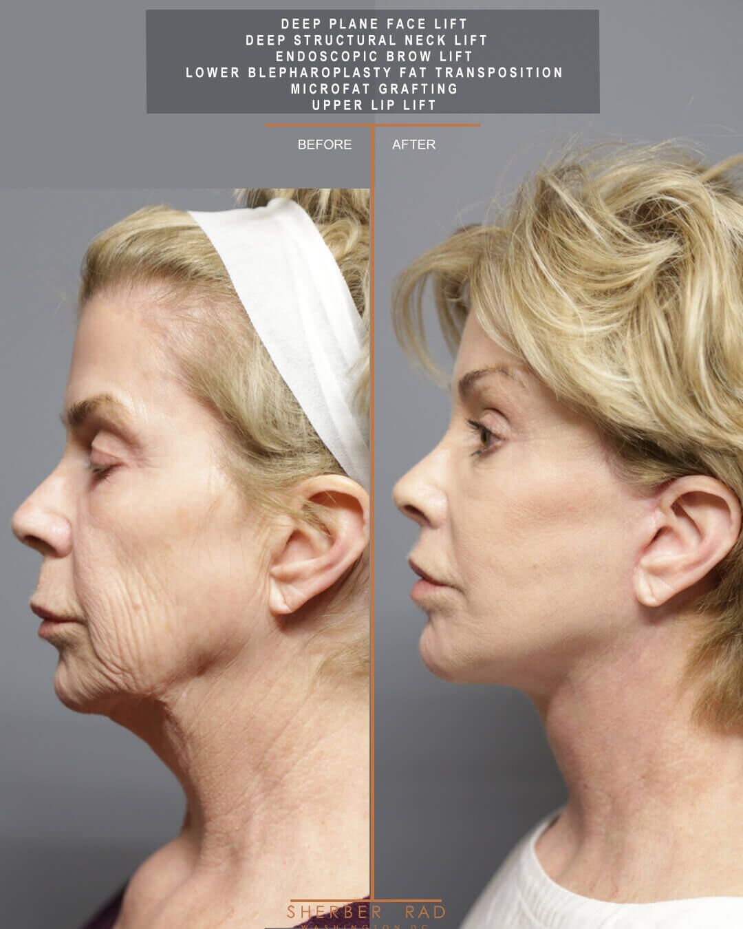Facial Optimization before and after photos by Sherber and Rad in Washington