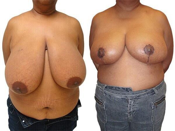 Breast Lift + Reduction before and after photos by Sherber and Rad in Washington, DC
