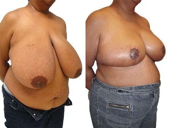 Breast Lift + Reduction before and after photos by Sherber and Rad in Washington, DC