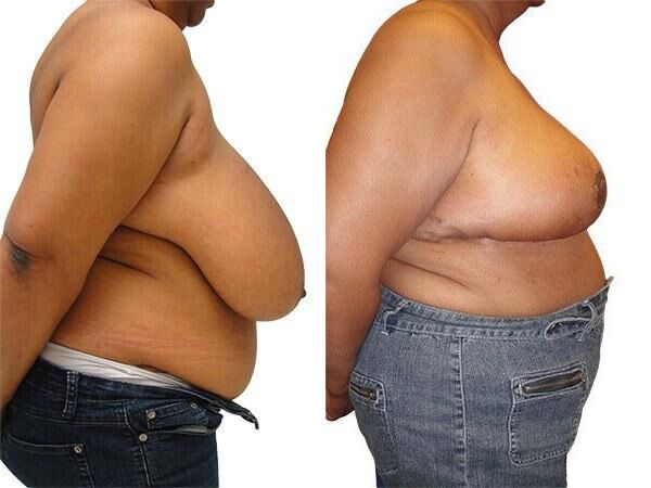 Breast Lift + Reduction before and after photos by Sherber and Rad in Washington, DC