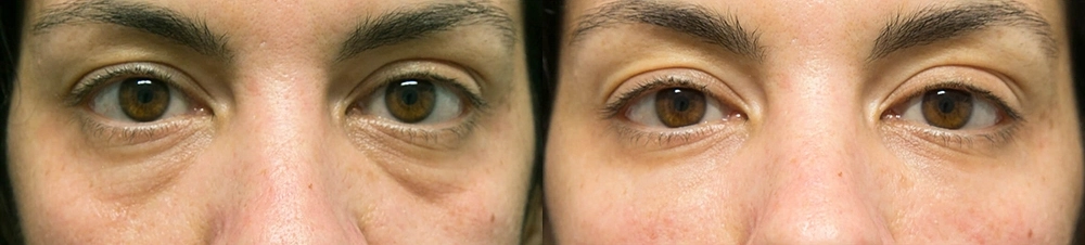 Under eye Bags + Dark Circles before and after photos by Sherber and Rad in Washington, DC