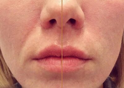 Nasolabial Folds Parentheses Lines before and after photos by Sherber and Rad in Washington, DC