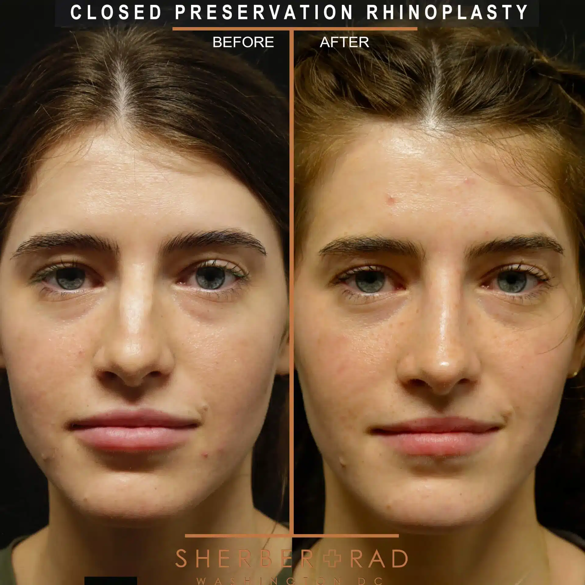 preservation rhinoplasty before and after photos by sherber and rad in washington dc