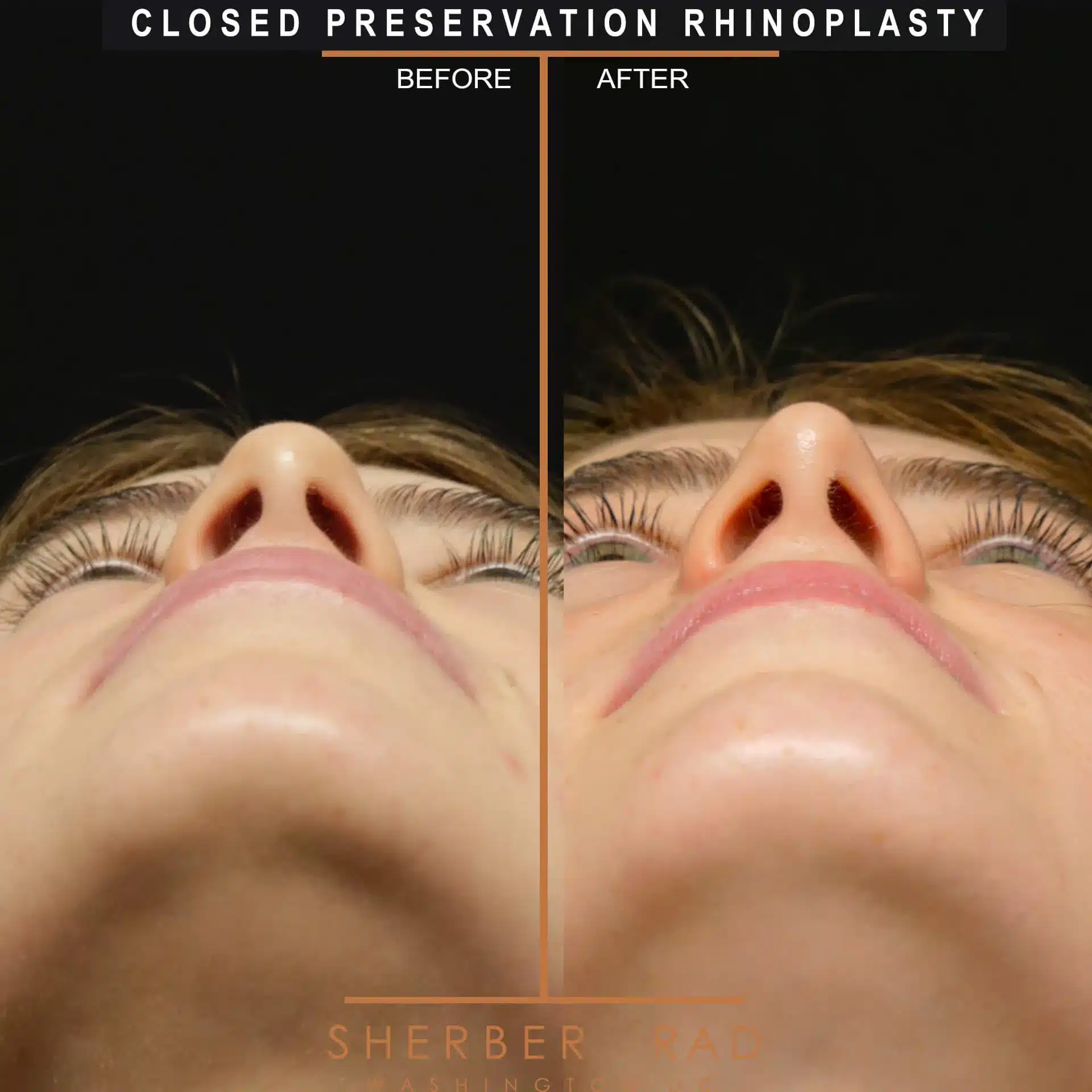 preservation rhinoplasty before and after photos by sherber and rad in washington dc