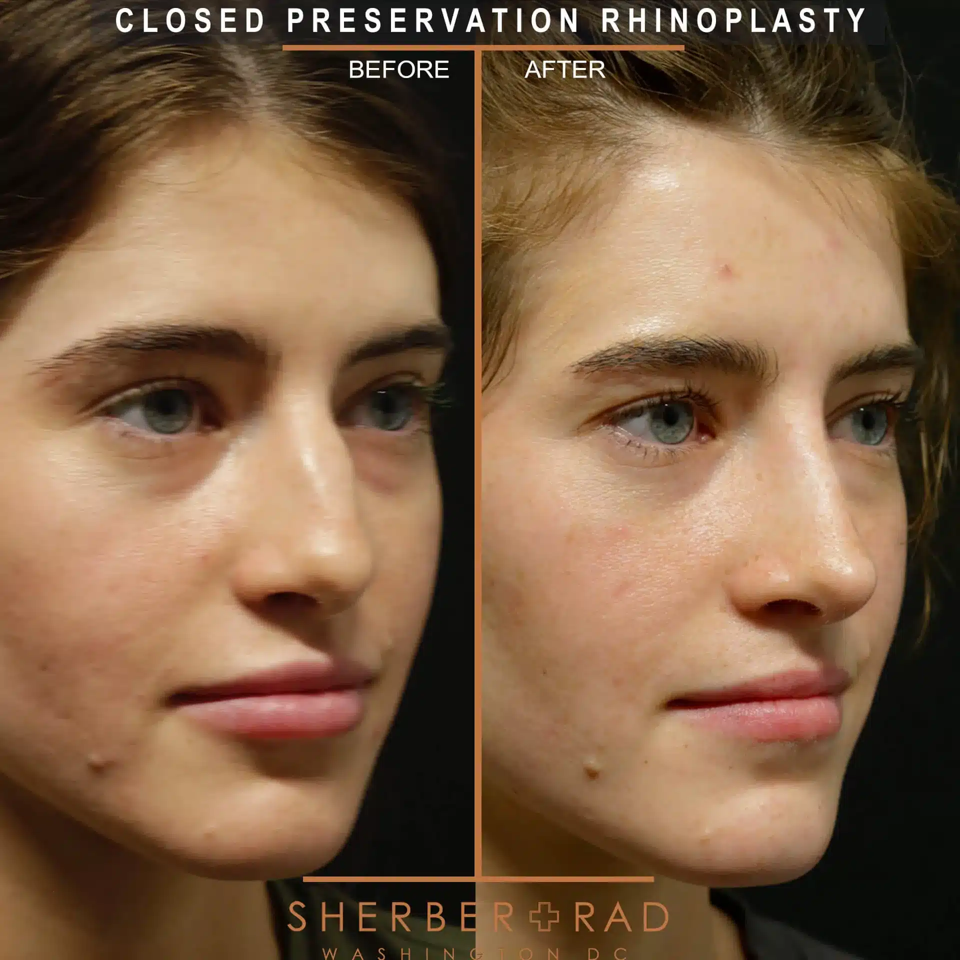 preservation rhinoplasty before and after photos by sherber and rad in washington dc