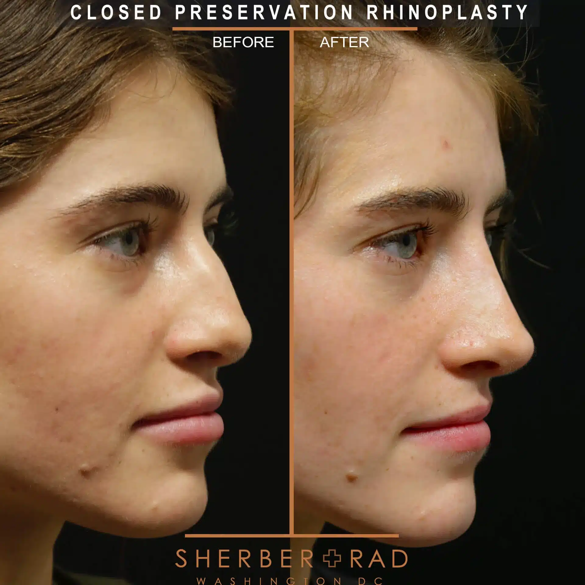 preservation rhinoplasty before and after photos by sherber and rad in washington dc