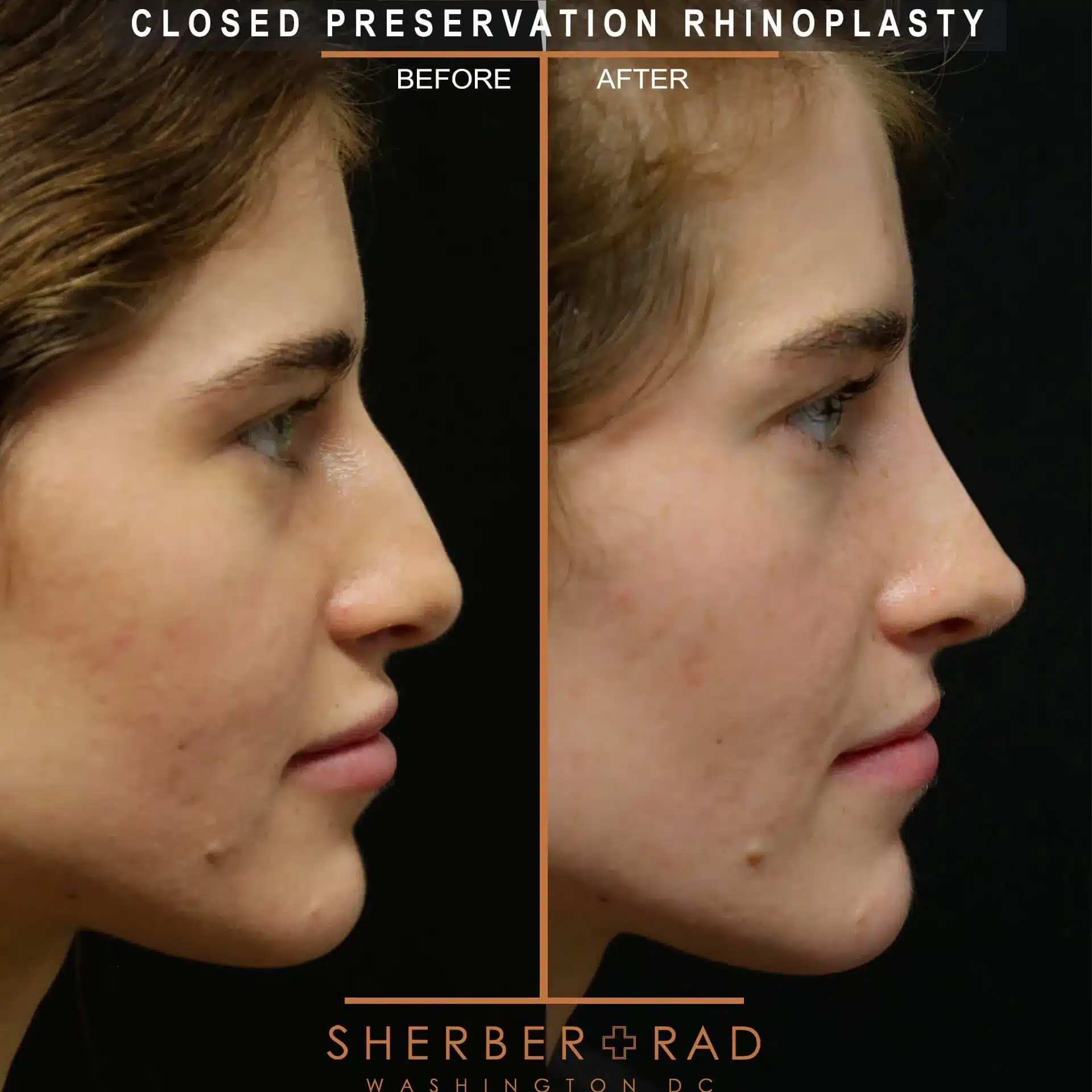 preservation rhinoplasty before and after photos by sherber and rad in washington dc