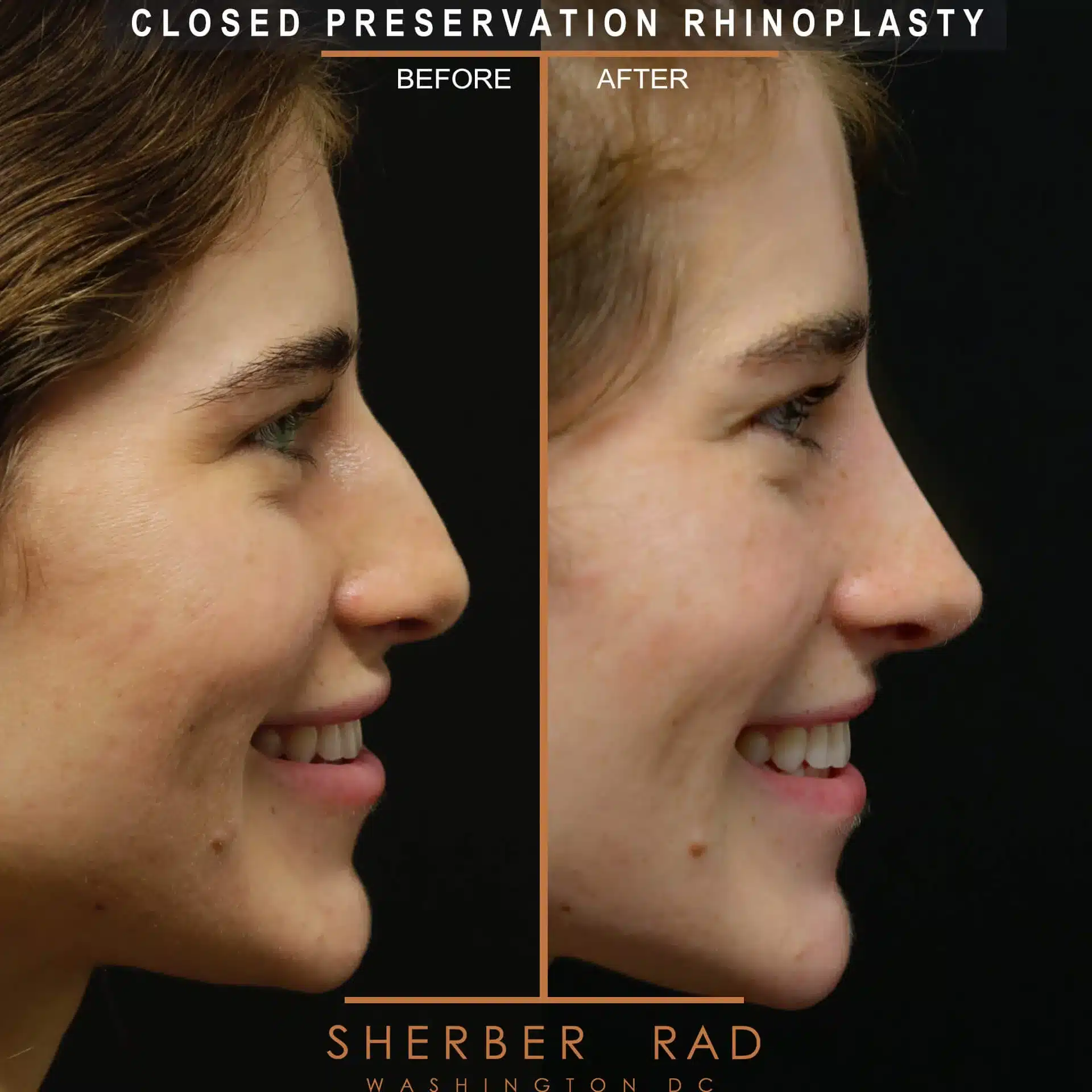 preservation rhinoplasty before and after photos by sherber and rad in washington dc