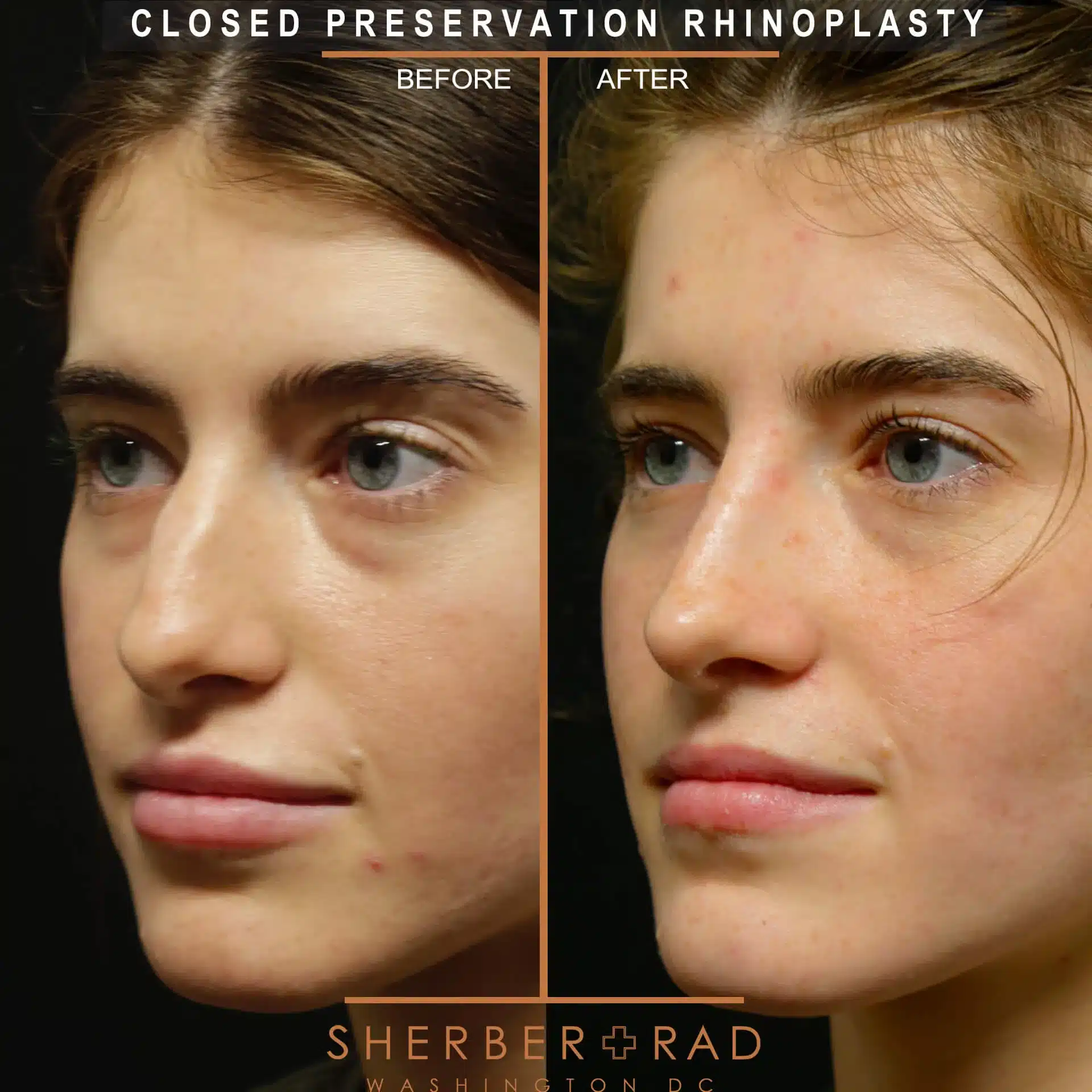 preservation rhinoplasty before and after photos by sherber and rad in washington dc