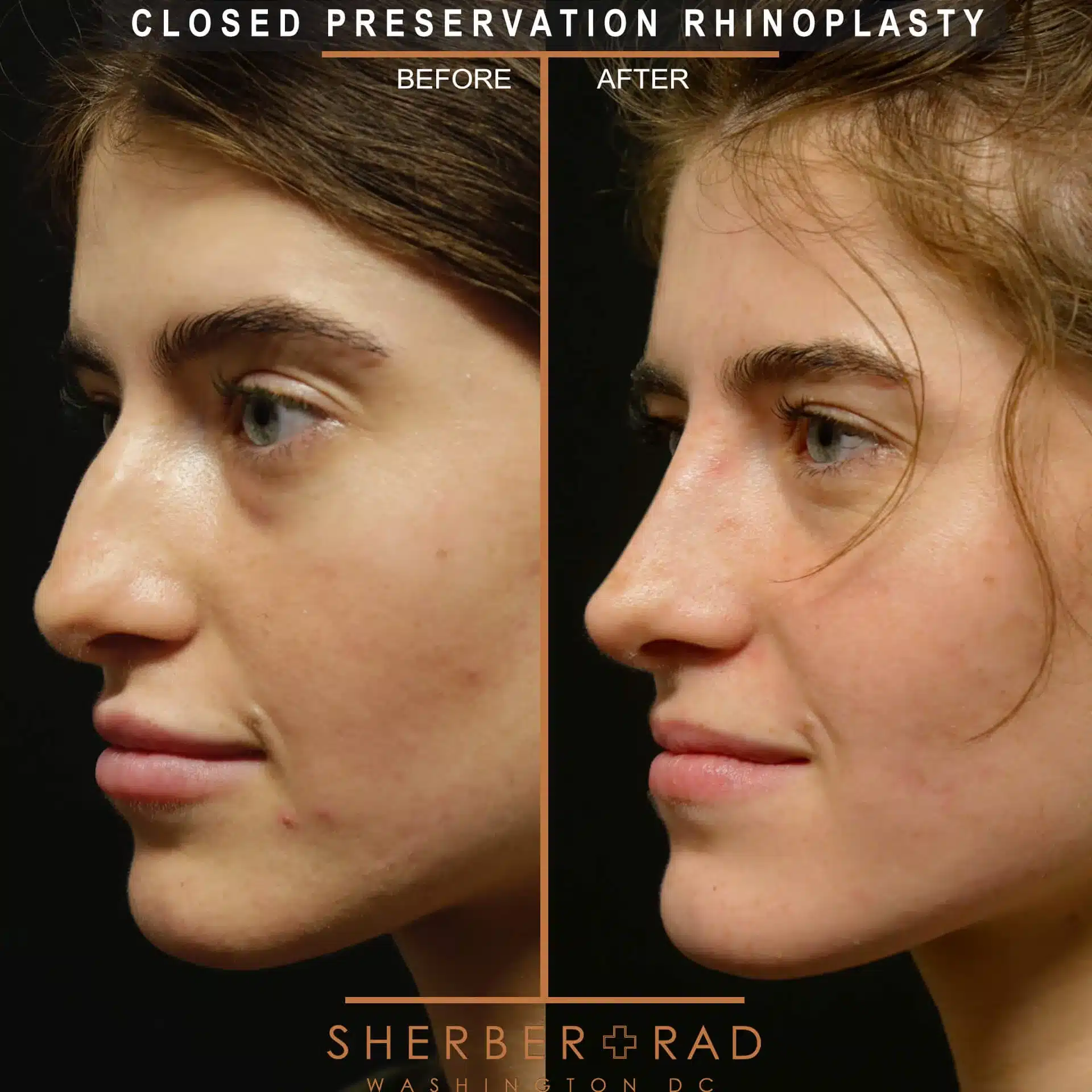 preservation rhinoplasty before and after photos by sherber and rad in washington dc