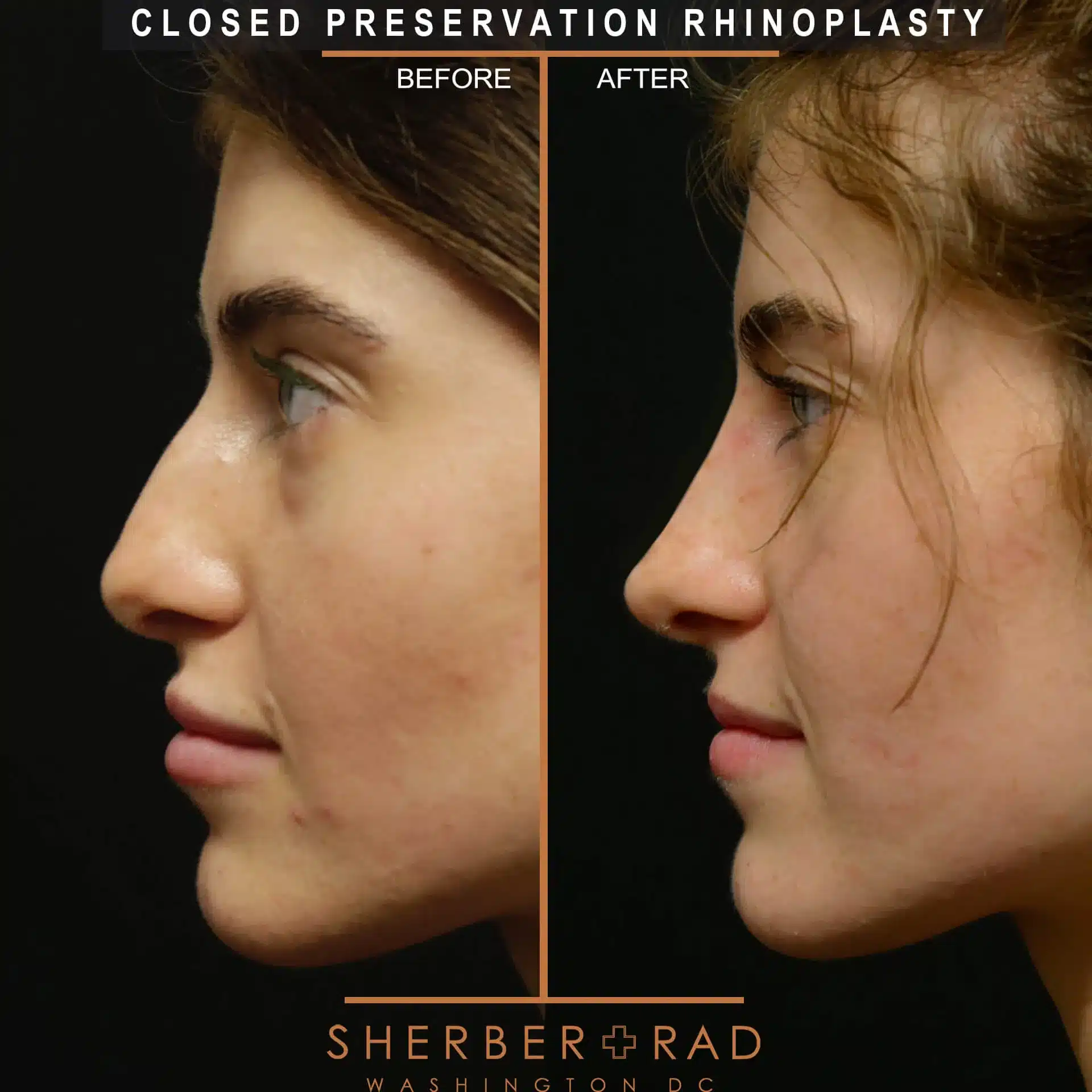 preservation rhinoplasty before and after photos by sherber and rad in washington dc