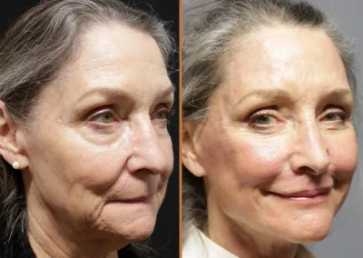 Deep Plane Facelift before and after photos by Sherber and Rad in Washington