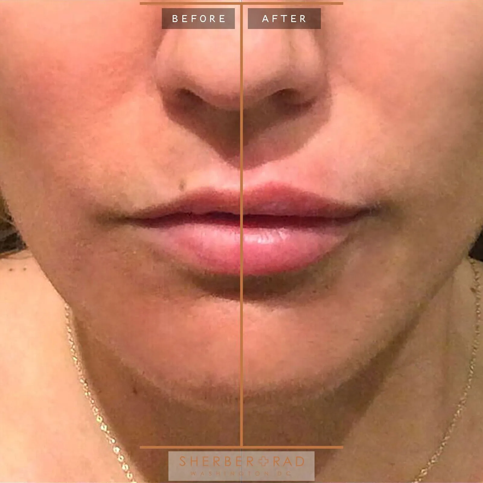 lip filler washington d.c. Lip Augmentation (Fat Transfer) in Washington DC