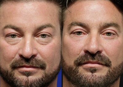 Facial Fat Transfer before and after photos by Sherber and Rad in Washington, DC