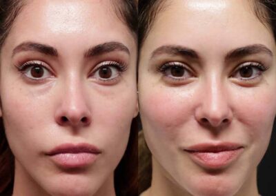 Facial Fat Transfer before and after photos by Sherber and Rad in Washington, DC