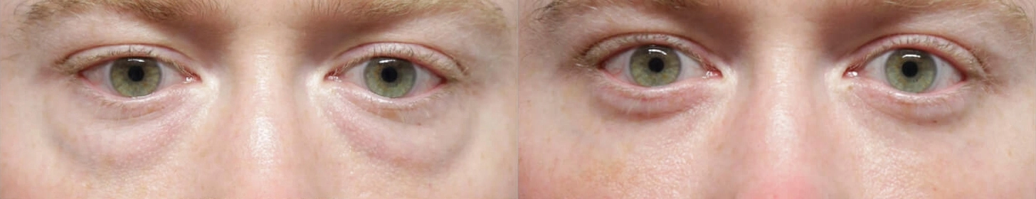 Facial Fat Transfer before and after photos by Sherber and Rad in Washington, DC