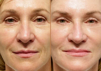 Facial Fat Transfer before and after photos by Sherber and Rad in Washington, DC