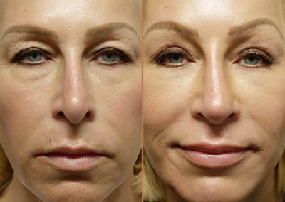 Facial Fat Transfer before and after photos by Sherber and Rad in Washington, DC
