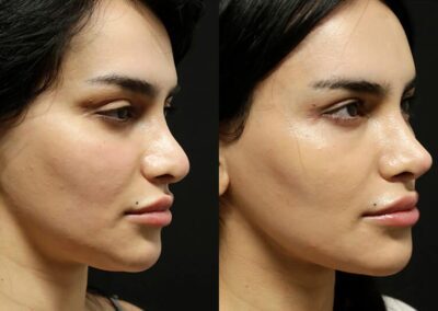 Facial Fat Transfer before and after photos by Sherber and Rad in Washington, DC