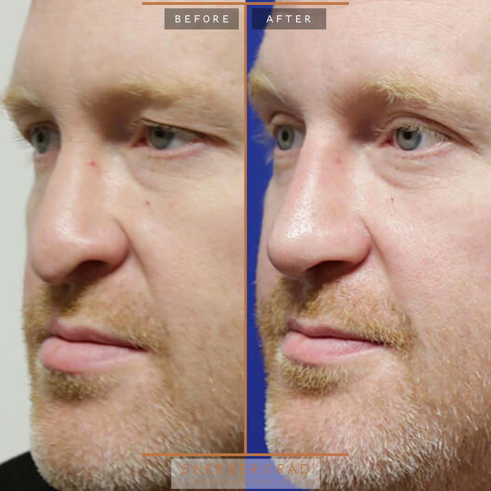 Rhinoplasty before and after photos by Sherber and Rad in Washington, DC