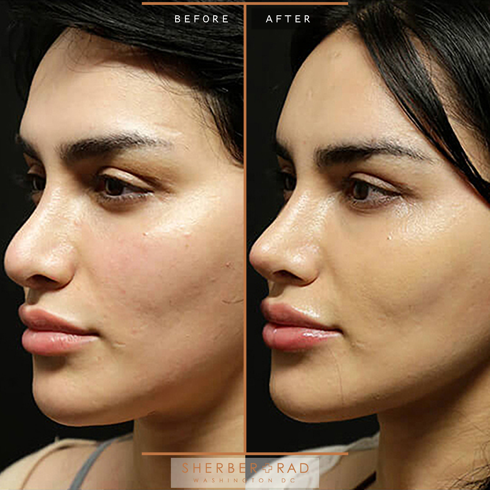 Rhinoplasty before and after photos by Sherber and Rad in Washington, DC