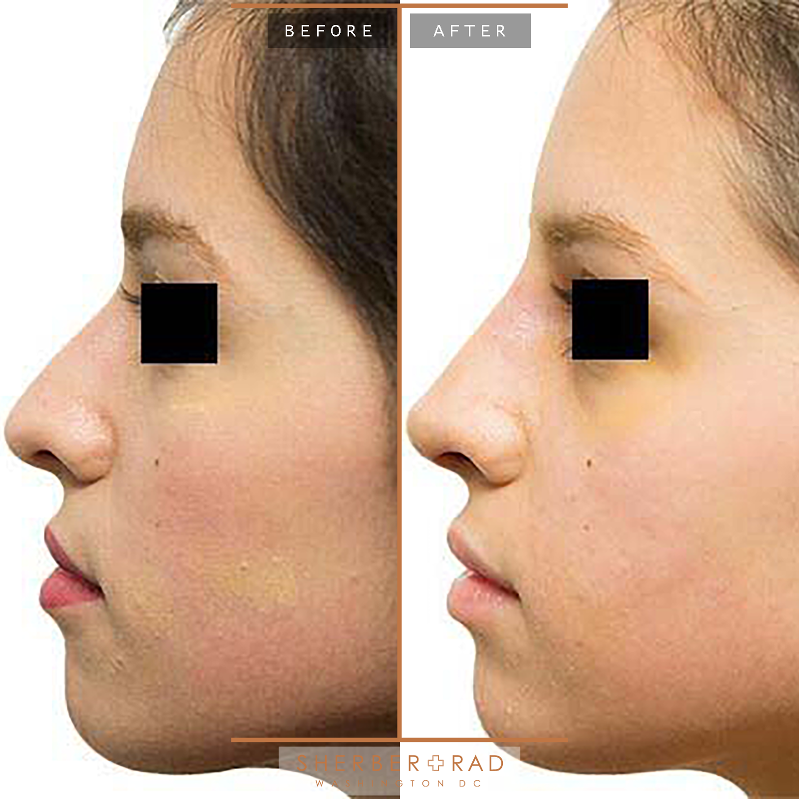 Rhinoplasty before and after photos by Sherber and Rad in Washington, DC