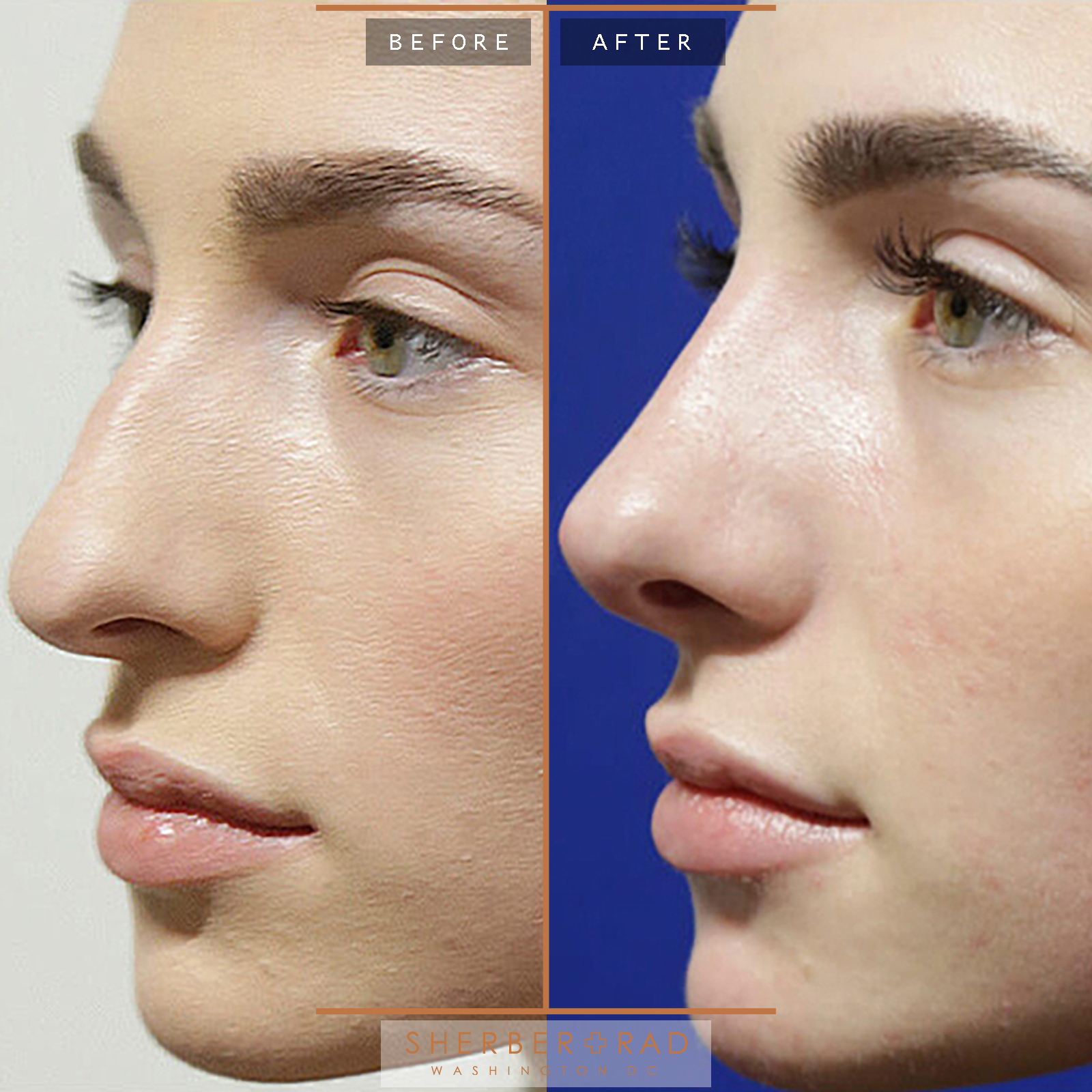 Rhinoplasty before and after photos by Sherber and Rad in Washington, DC
