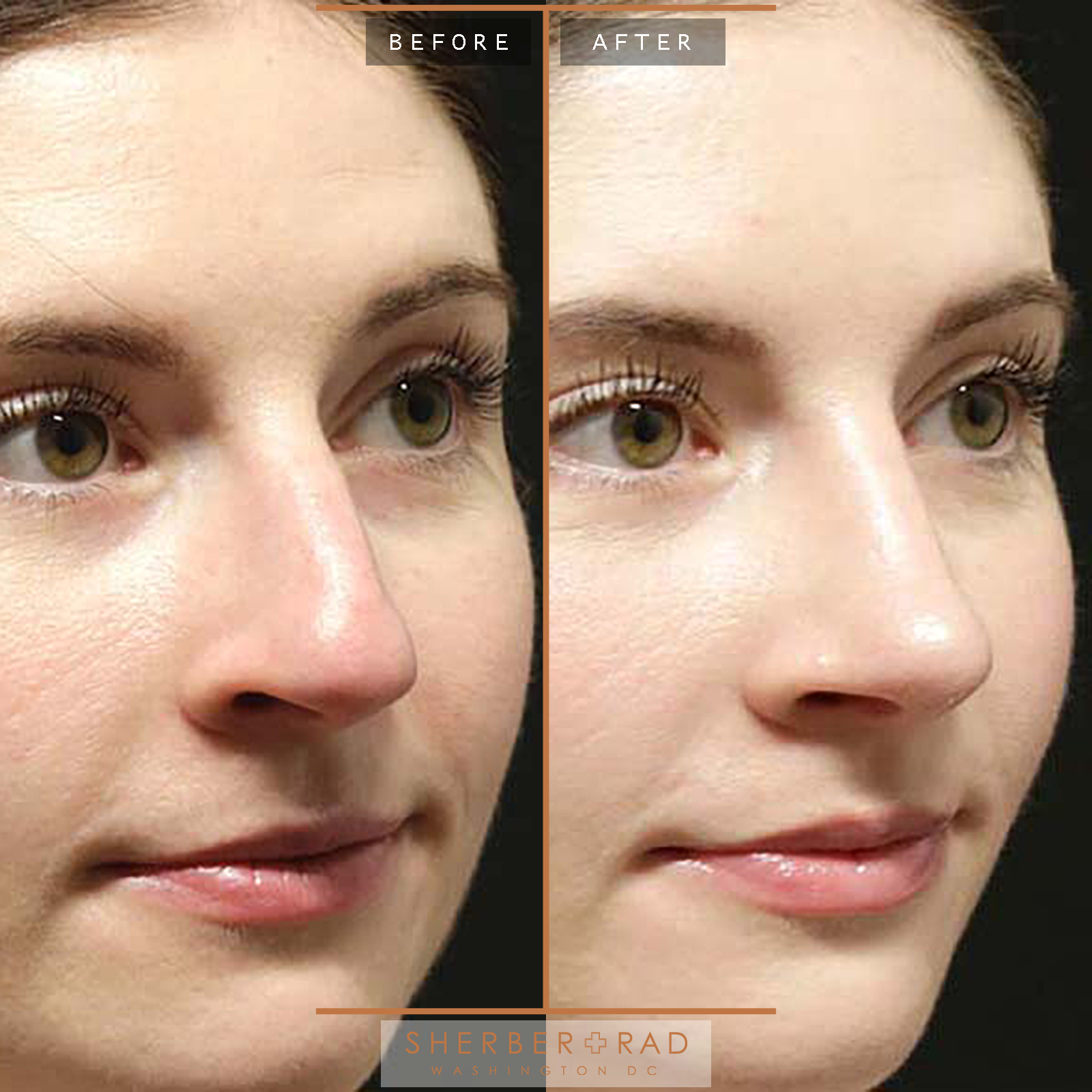 Rhinoplasty before and after photos by Sherber and Rad in Washington, DC