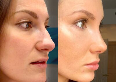 Facial Fat Transfer before and after photos by Sherber and Rad in Washington, DC