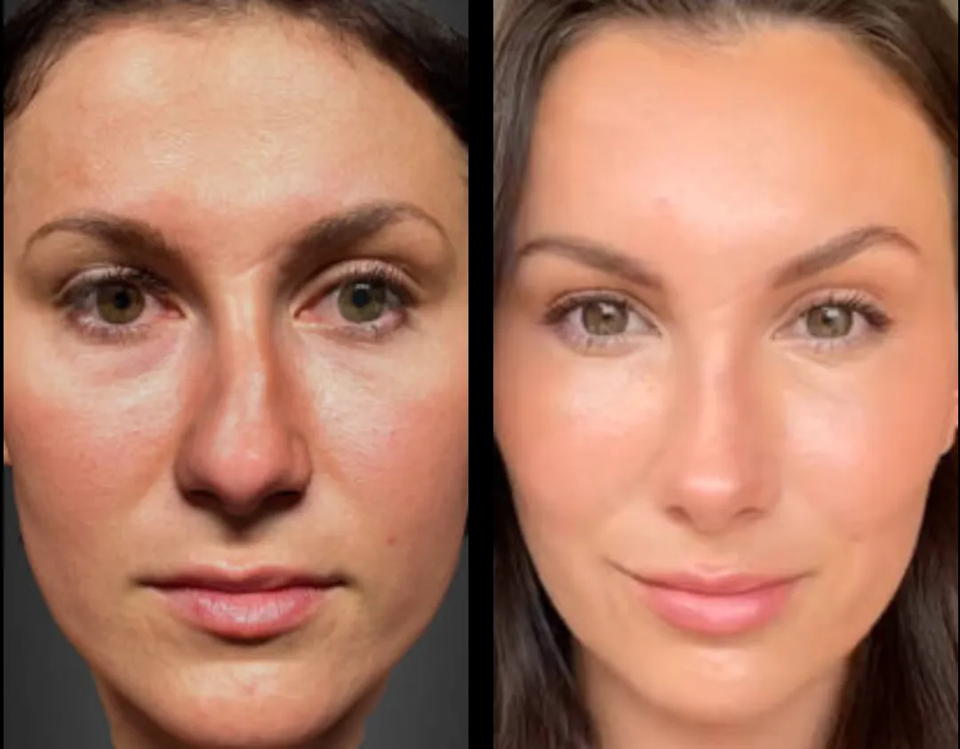 closed rhinoplasty before and after results
