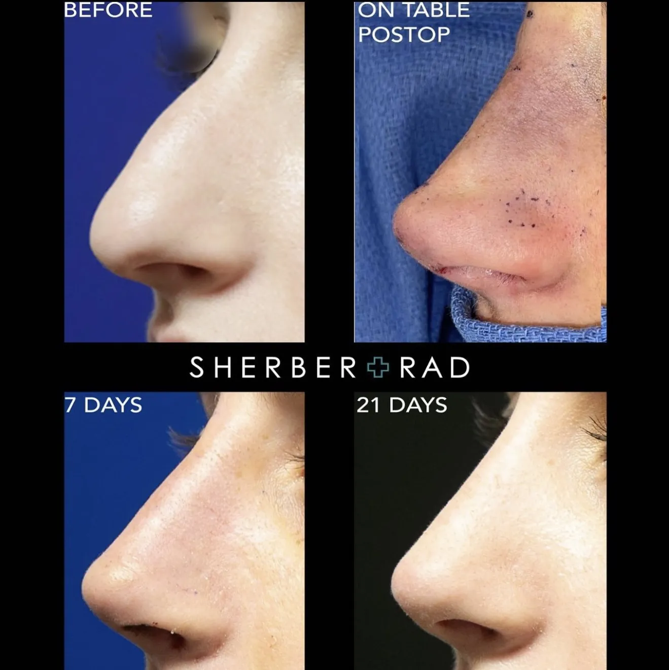 closed rhinoplasty before and after results