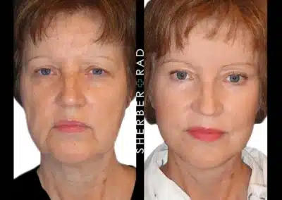 Deep Plane Facelift before and after photos by Sherber and Rad in Washington