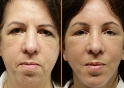 Deep Plane Facelift before and after photos by Sherber and Rad in Washington