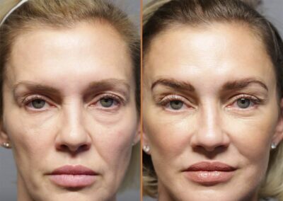 deep plane facelift before and after photos by sherber and rad in washington dc