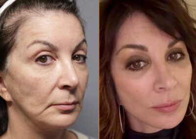 deep plane facelift before and after photos by sherber and rad in washington dc