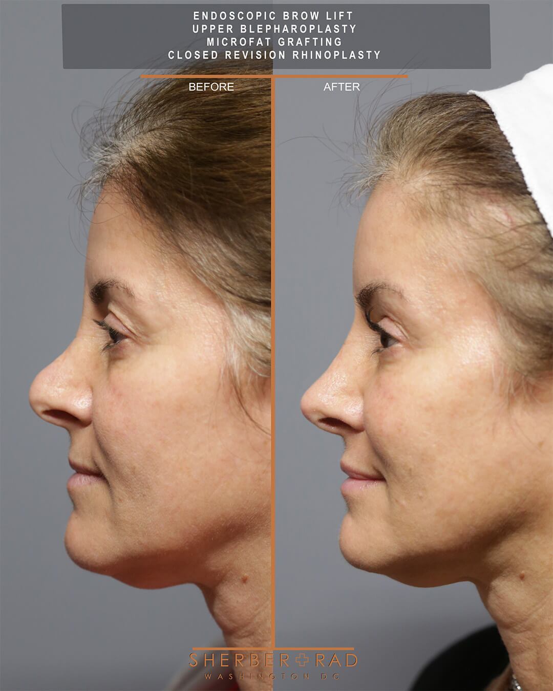 Brow Lift and Rhinoplasty before and after photos by Sherber and Rad in Washington DC