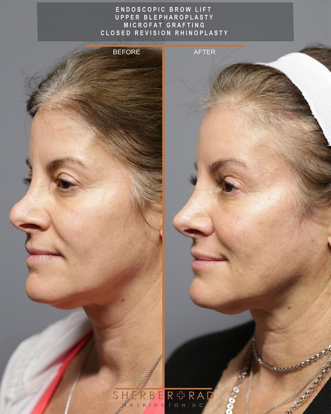 Brow Lift and Rhinoplasty before and after photos by Sherber and Rad in Washington DC