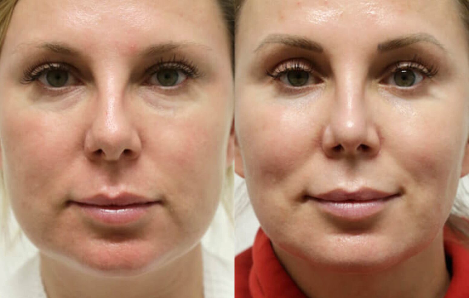 Buccal Fat Removal before and after photos by Sherber and Rad in Washington, DC