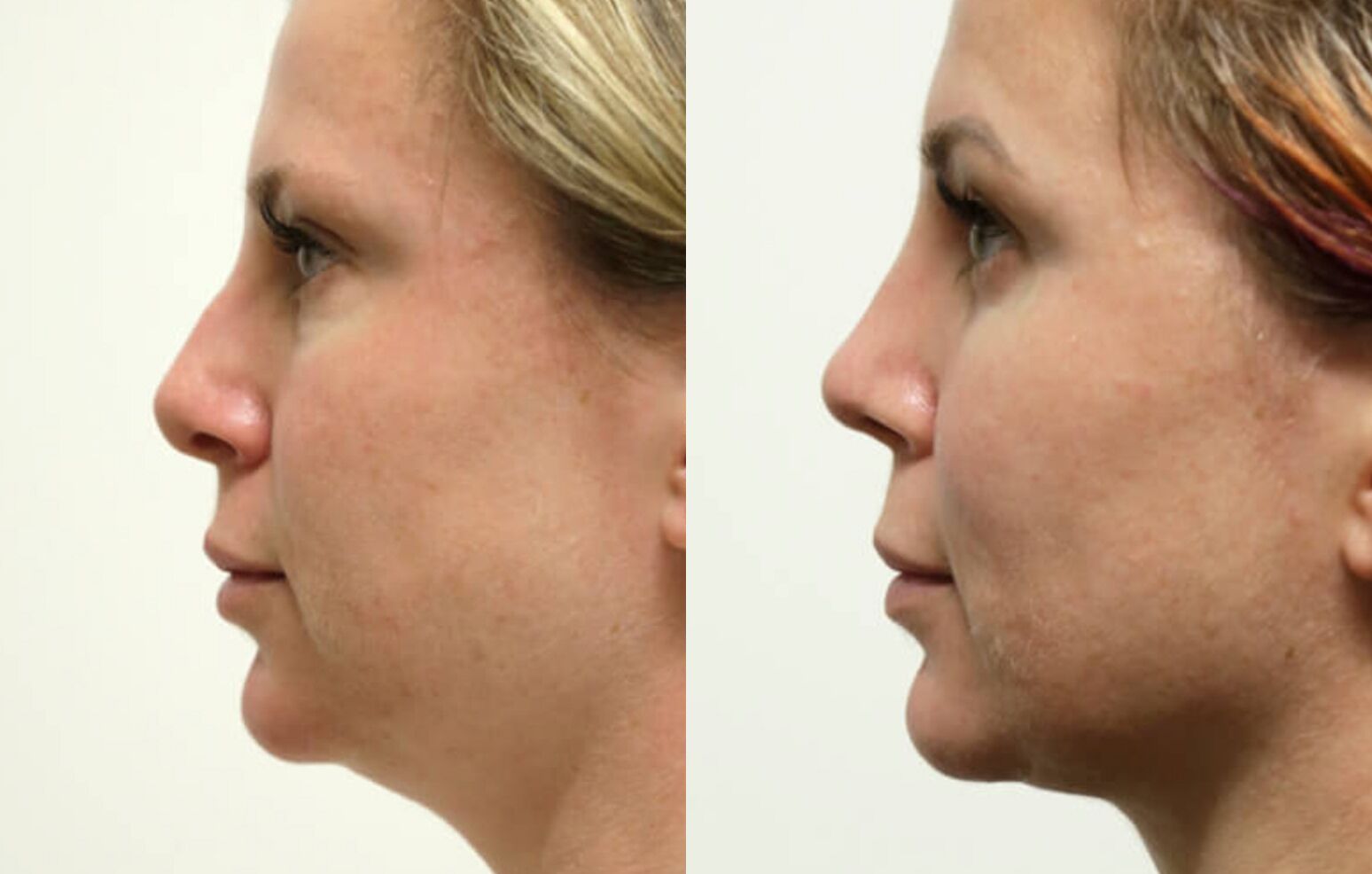 Buccal Fat Removal before and after photos by Sherber and Rad in Washington, DC