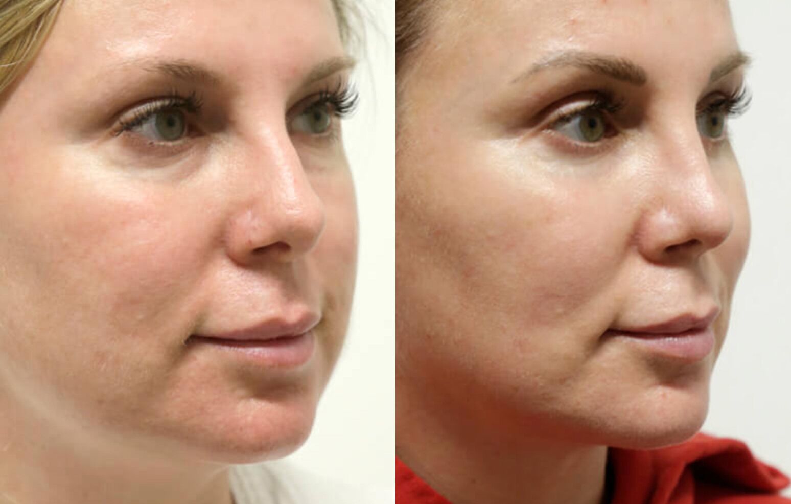 Buccal Fat Removal before and after photos by Sherber and Rad in Washington, DC