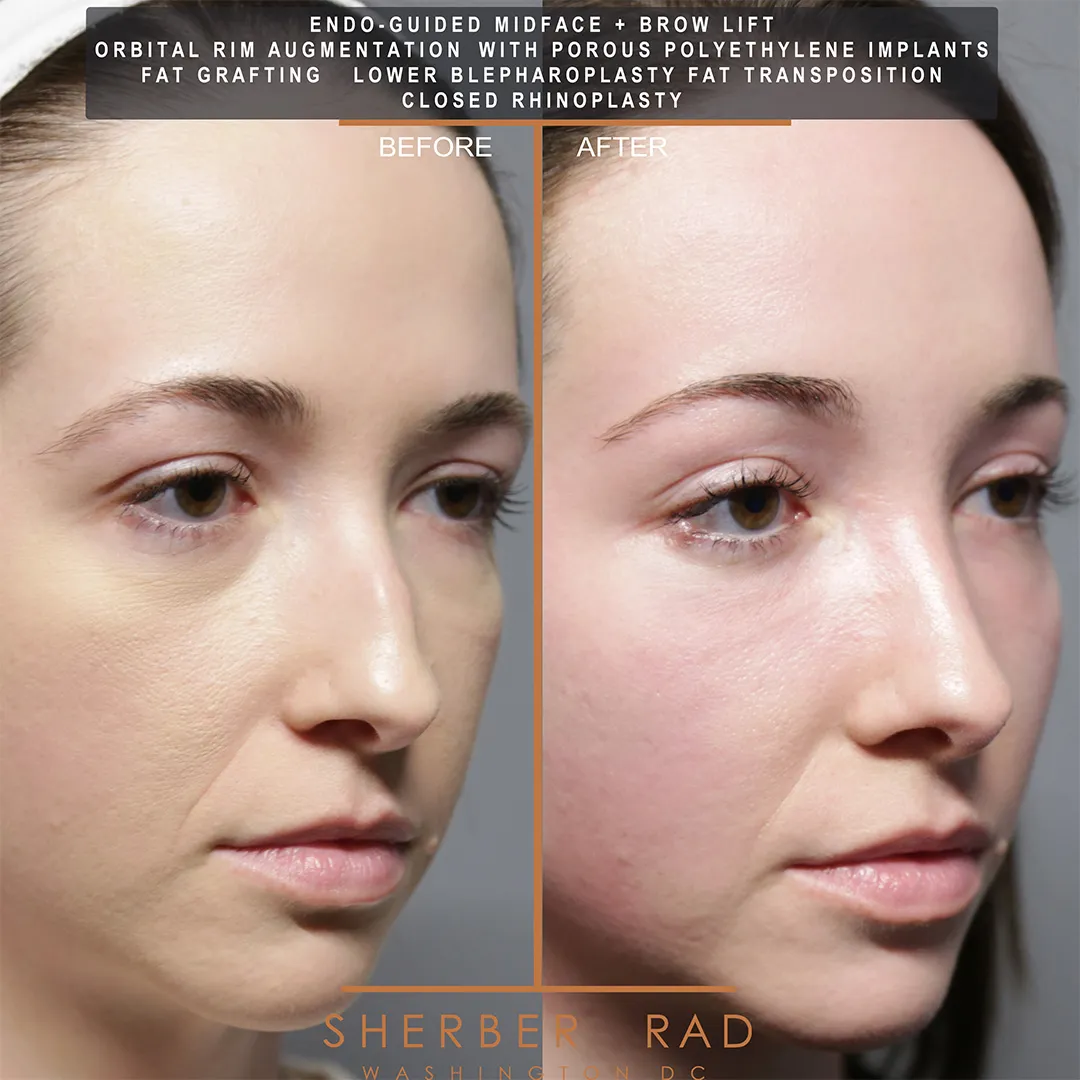 Facial Implants before and after photos by Sherber and Rad in Washington DC