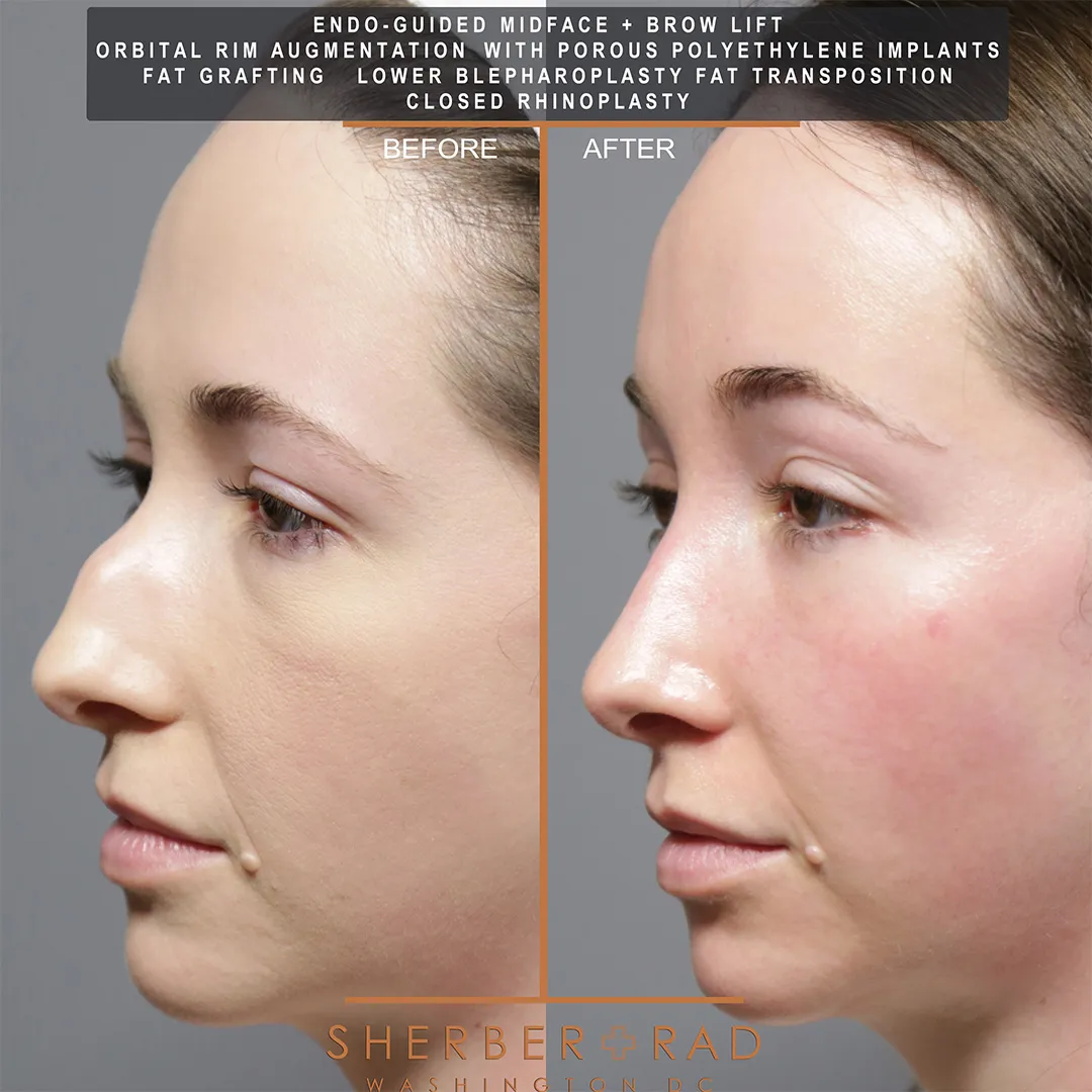 Facial Implants before and after photos by Sherber and Rad in Washington DC