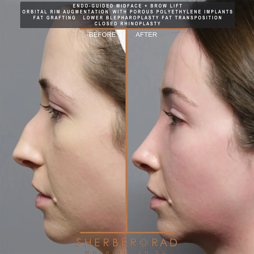 Facial Implants before and after photos by Sherber and Rad in Washington DC